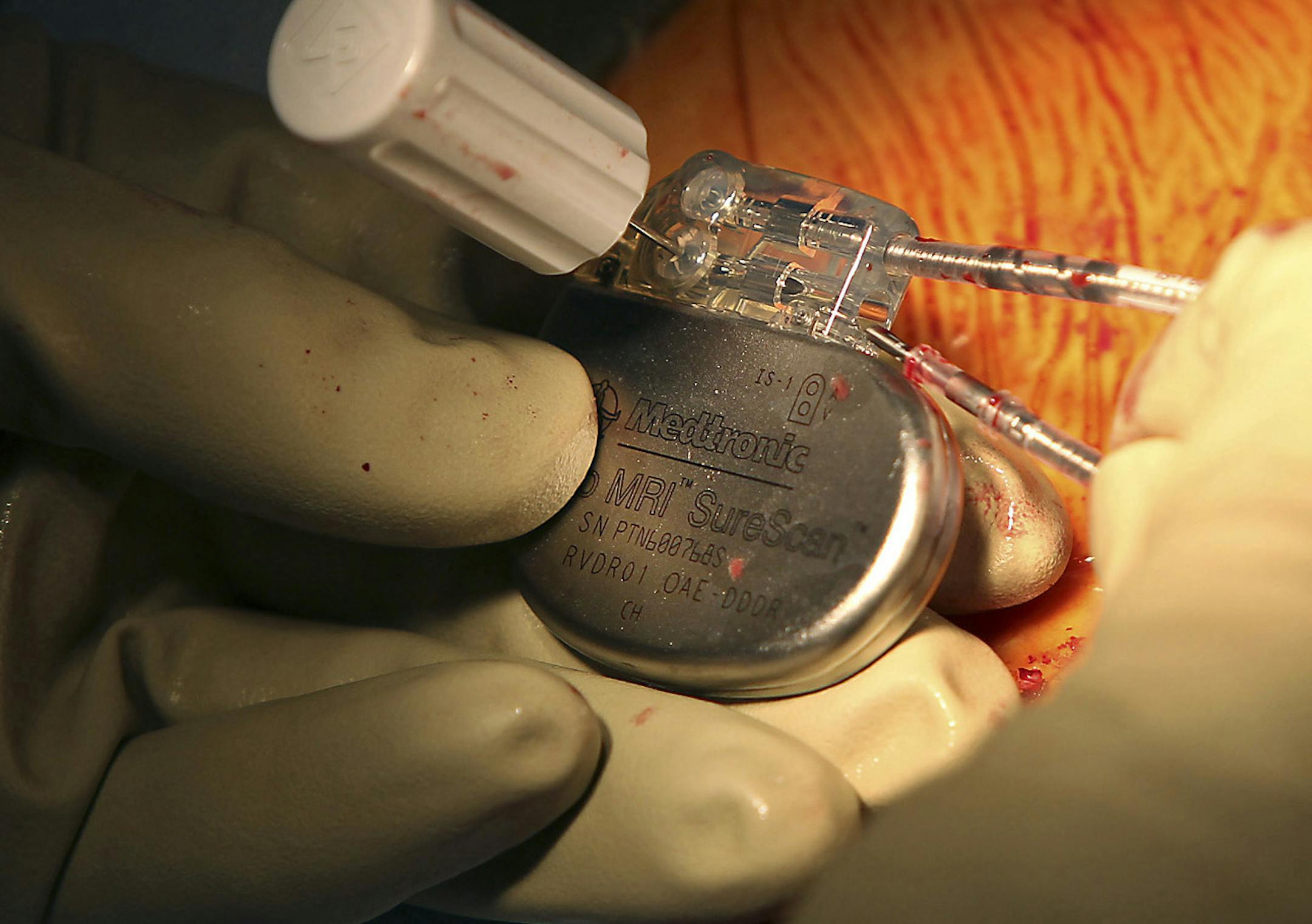 ELIZABETH FLORES &#xac;&#x2022; eflores@startribune.com February 24, 2011 - St. Louis Park, MN - Most people don't realize that pacemakers and MRI scans don't mix. But last week, Medtronic received FDA approval for its MRI-compatible pacemaker. This is the first patient in the Twin Cities to get the new device. We will also interview the surgeon after the procedure. IN THIS PHOTO:] Dr. Jeffrey Shultz installed one of the first FDA approved MRI-compatible pacemakers into Gerald Morton, 65, at Met