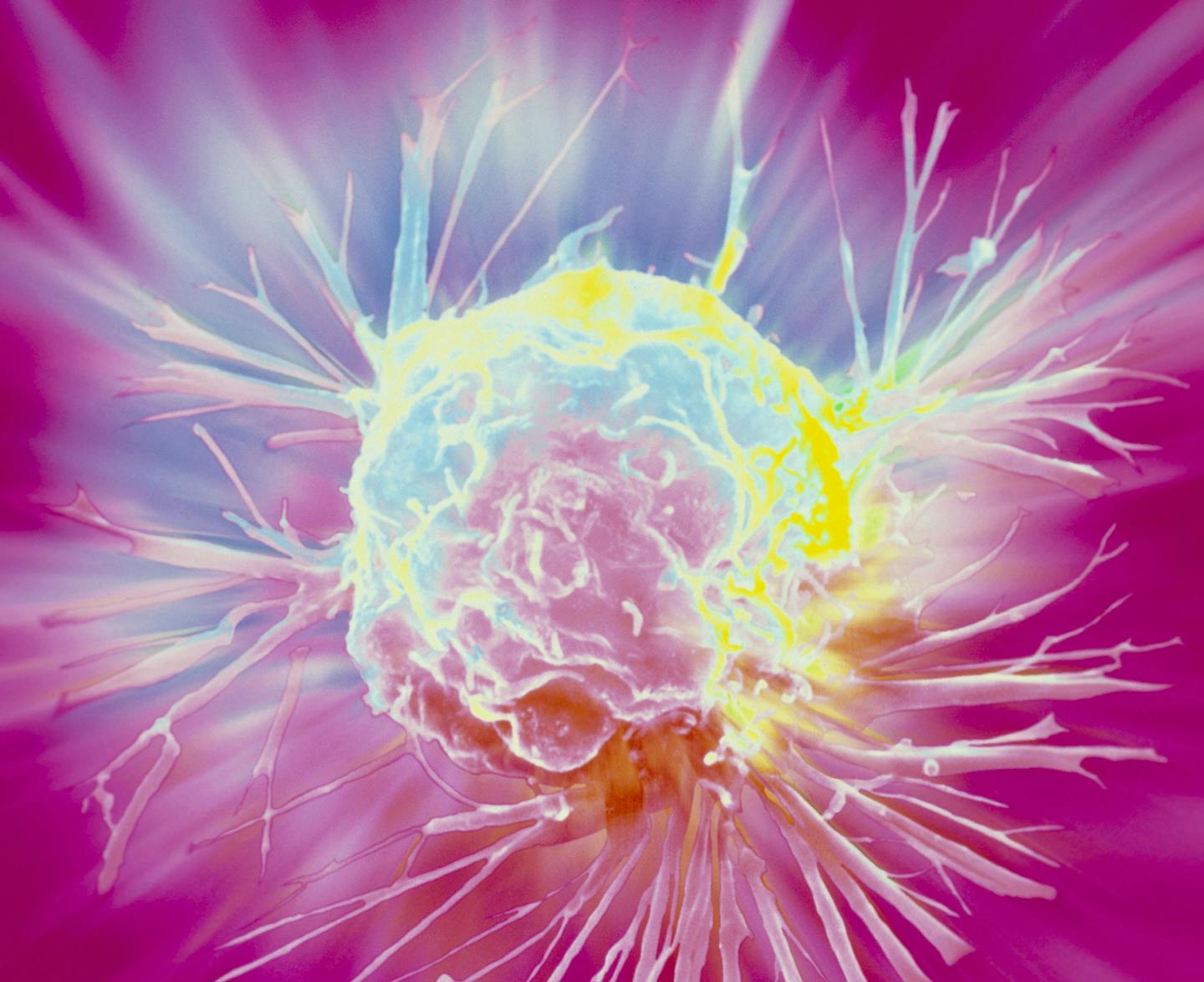 Breast cancer cell. Coloured scanning electron micrograph (SEM) of a single breast cancer cell, showing its uneven surface and cytoplasmic projections. Clumps of cancerous (malignant) cells form tumours, which possess the ability to invade and destroy surrounding tissues and travel to distant parts of the body to seed secondary tumours. Malignant cells proliferate and grow in a chaotic manner, with defective cell division retained within each new generation of cells. Variations also occur in siz