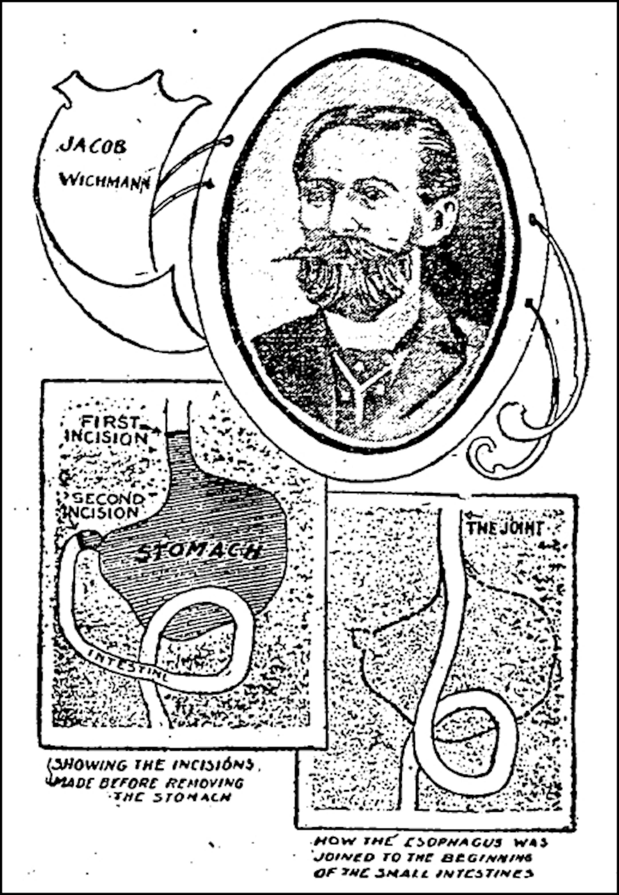 April 6, 1901: Man without a stomach