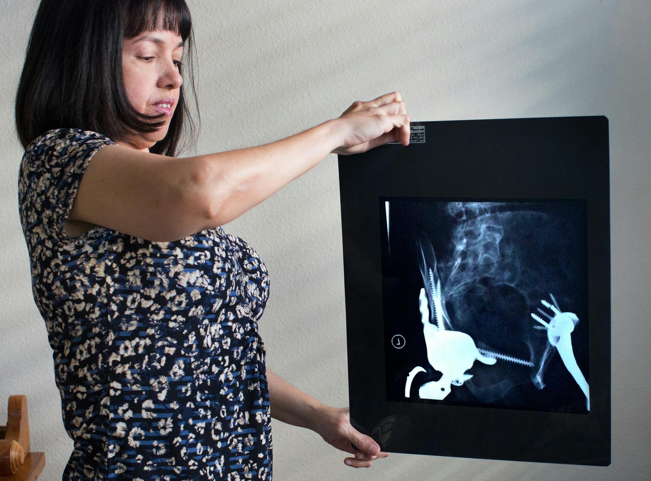 Sylvia Gonzalez holds an X-Ray showing her two hip and pelvis replacement. Gonzalez suffered from juvenile rheumatoid arthritis and ankylosing spondylitis which locked up her spine. She started getting artificial joints implanted at age 18. She has artificial hips, artificial knees, an artificial ankle, and artificial shoulder. Her spine has been fused so she can&#x201a;&#xc4;&#xf6;&#x221a;&#xd1;&#x221a;&#x2202;&#x201a;&#xe0;&#xf6;&#x221a;&#xeb;&#x201a;&#xe0;&#xf6;&#xac;&#x2022;t turn her head.