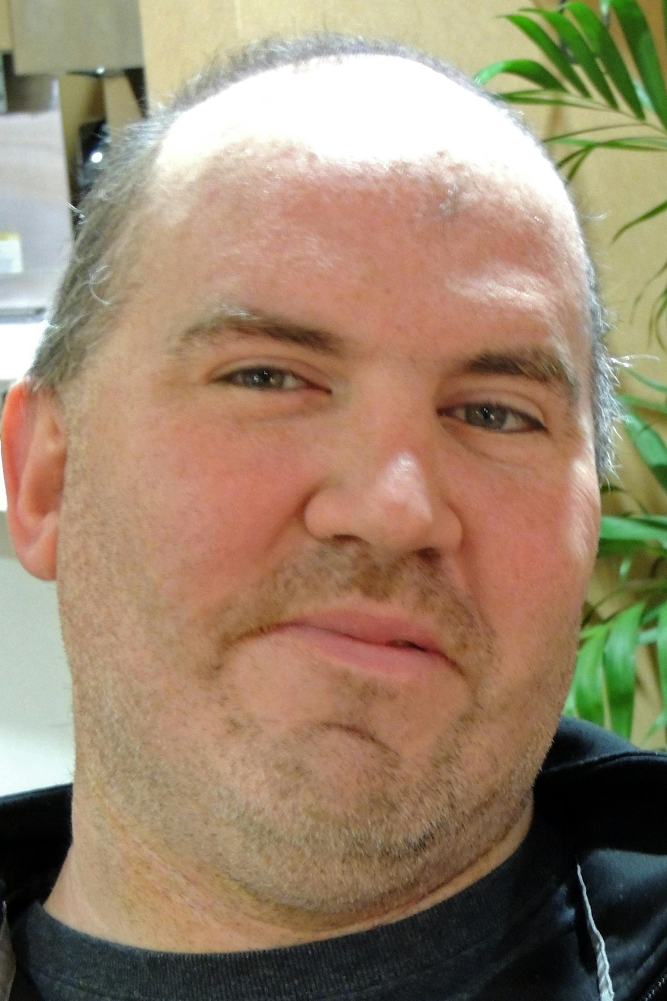 Steven Byboth was the first patient in Minnesota to receive the tiny device.