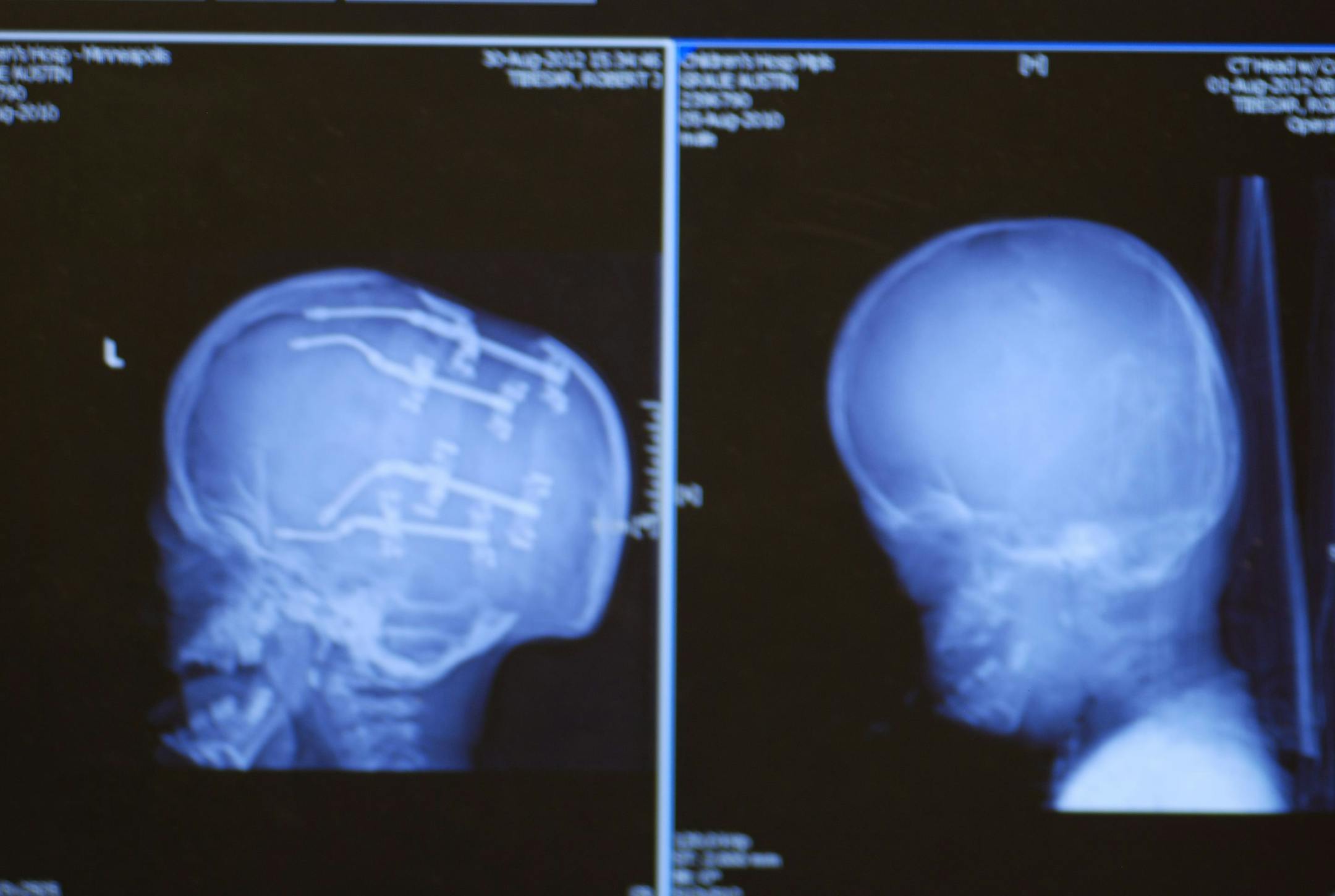 Before (right) and after (left) X-rays of Austin's skull