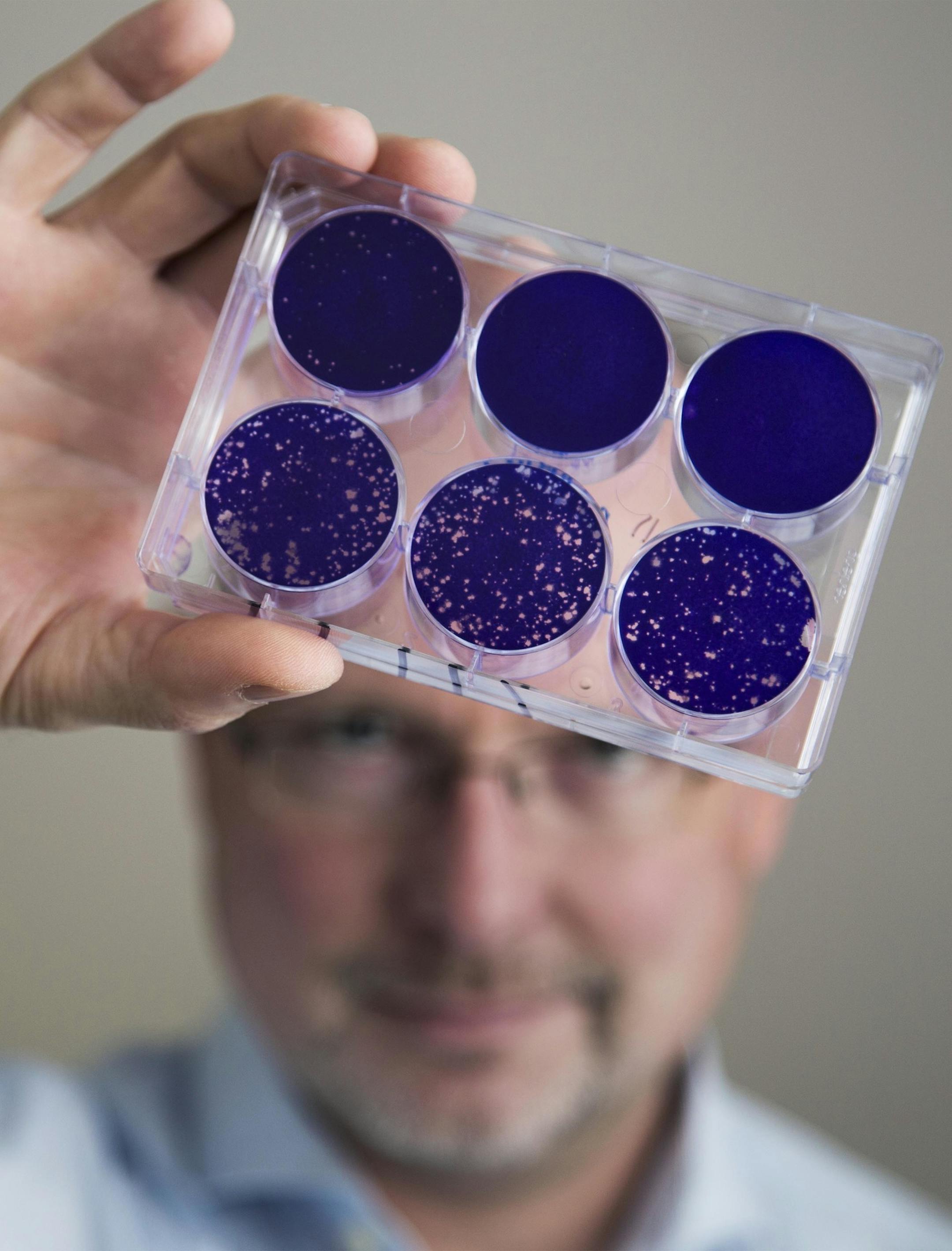 In this Aug. 8, 2013 photo provided by Duke University, Dr. Matthias Gromeier holds samples of the modified poliovirus he developed to attack glioblastoma brain tumor cells at Duke in Durham, N.C. One of the world's most dreaded viruses has been turned into an immune system therapy to fight deadly brain tumors. Survival was better than expected for patients in a small study treated with the modified poliovirus, which helped their bodies attack their cancer, doctors reported on Tuesday, June 26,