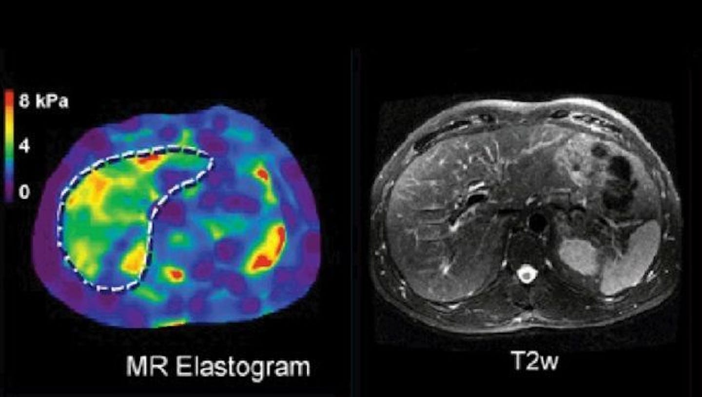 These are two images of an actual patient's liver, comparing an image from Resoundant's magnetic resonance elastrography, or MRE scan, on the left, with a standard MRI image of the same's patient's liver. The standard MRI image shows nothing unusual in the patient's liver, while the MRE image shows a greater level of stiffness in the liver tissue, which may indicate disease.