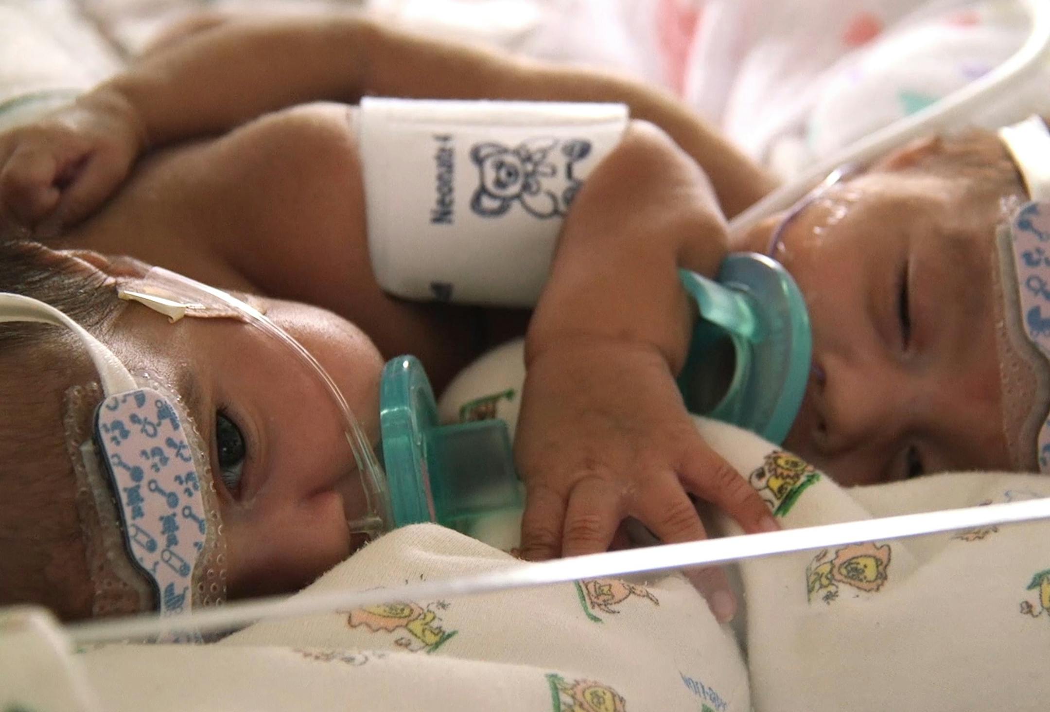 Conjoined twins Paisleigh and Paislyn Martinez, seen at 6 weeks, were separated in a nine-hour surgery at the University of Minnesota Masonic Children's Hospital on May 25.