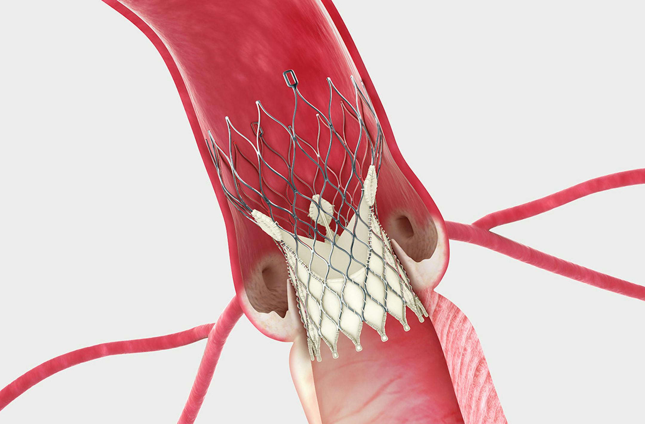 The Medtronic CoreValve¬Æ System sits within the same area as the native valve