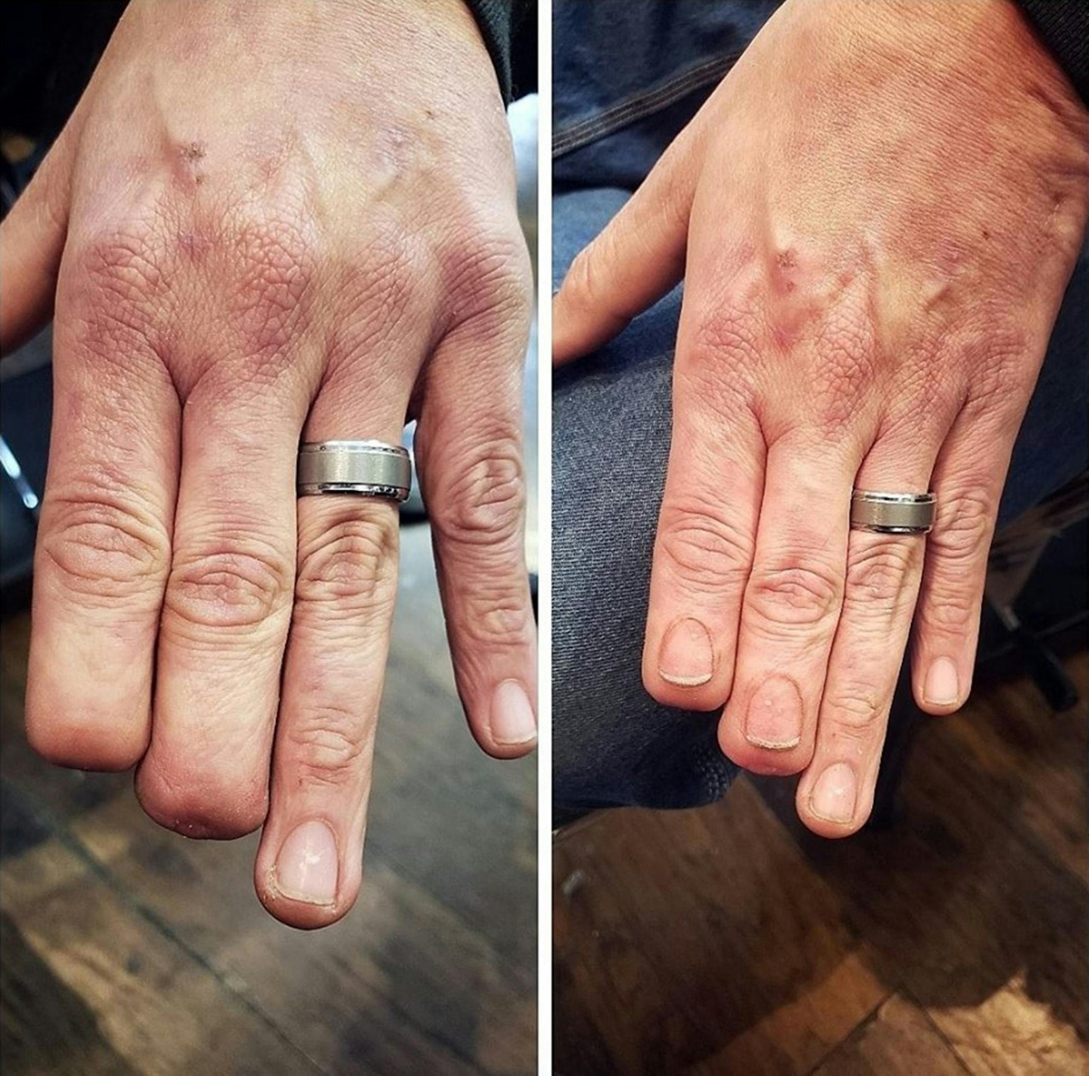 Mark Bertram lost the tips of two fingers in a construction accident last year. Bertram was trapped in a fan belt at work when the tips of his fingers were severed off. Eric Catalano tattooed fingernails for Bertram.
