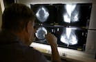 A radiologist checked mammograms in Los Angeles. A specialist at MD Anderson Cancer Center said the results stress the need to get regular mammograms.