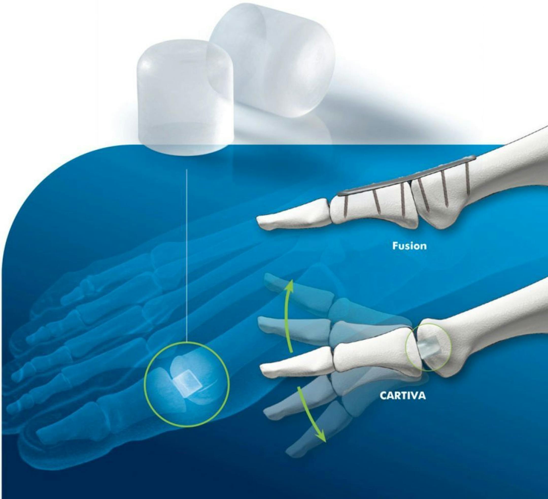The Cartiva Synthetic Cartilage Implant was approved by the FDA in July 2016 to treat big-toe arthritis.