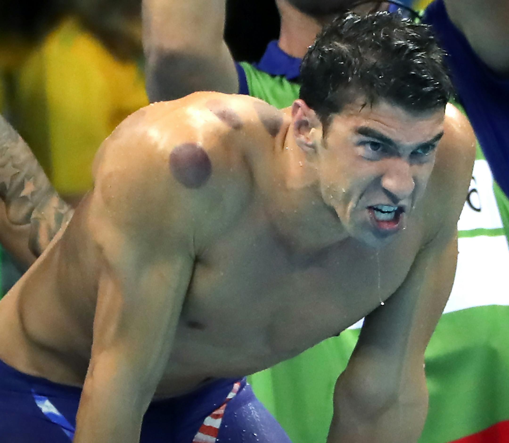 Olympic swimming sensation Michael Phelps is certainly making his mark in Rio, sporting large circular bruises on his body over the weekend. They were the tell-tale signs of a healing technique called ìcuppingî used by a growing number of athletes to loosen tight muscles and speed up recovery time. ] 2016 Summer Olympic Games - Rio Brazil brian.peterson@startribune.com Rio de Janeiro, Brazil - 08/07/2016 ORG XMIT: MIN1608081610460910