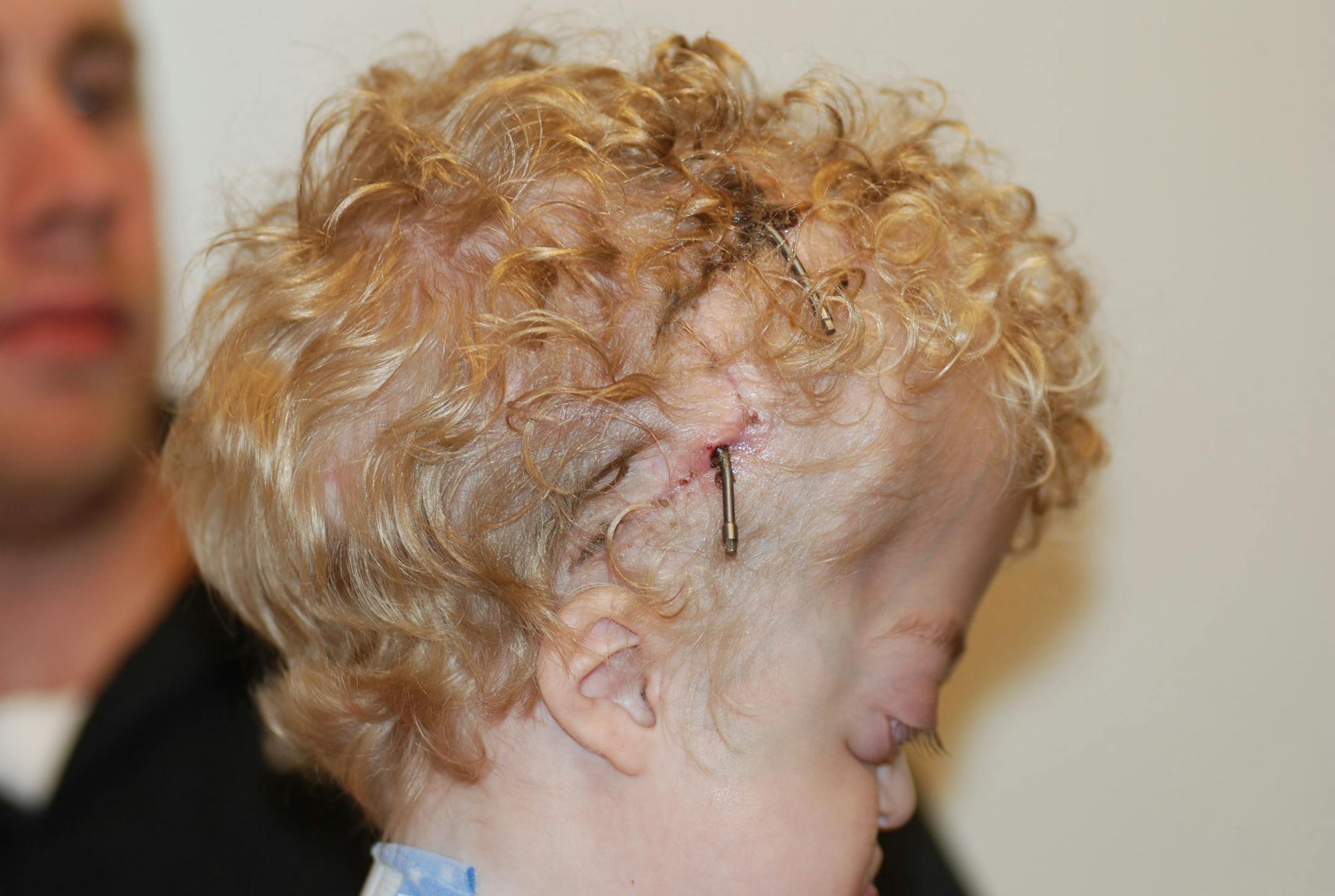 Doctors opened Austin's skull and attached four "distractors" over his head to allow his skull to expand and grow.