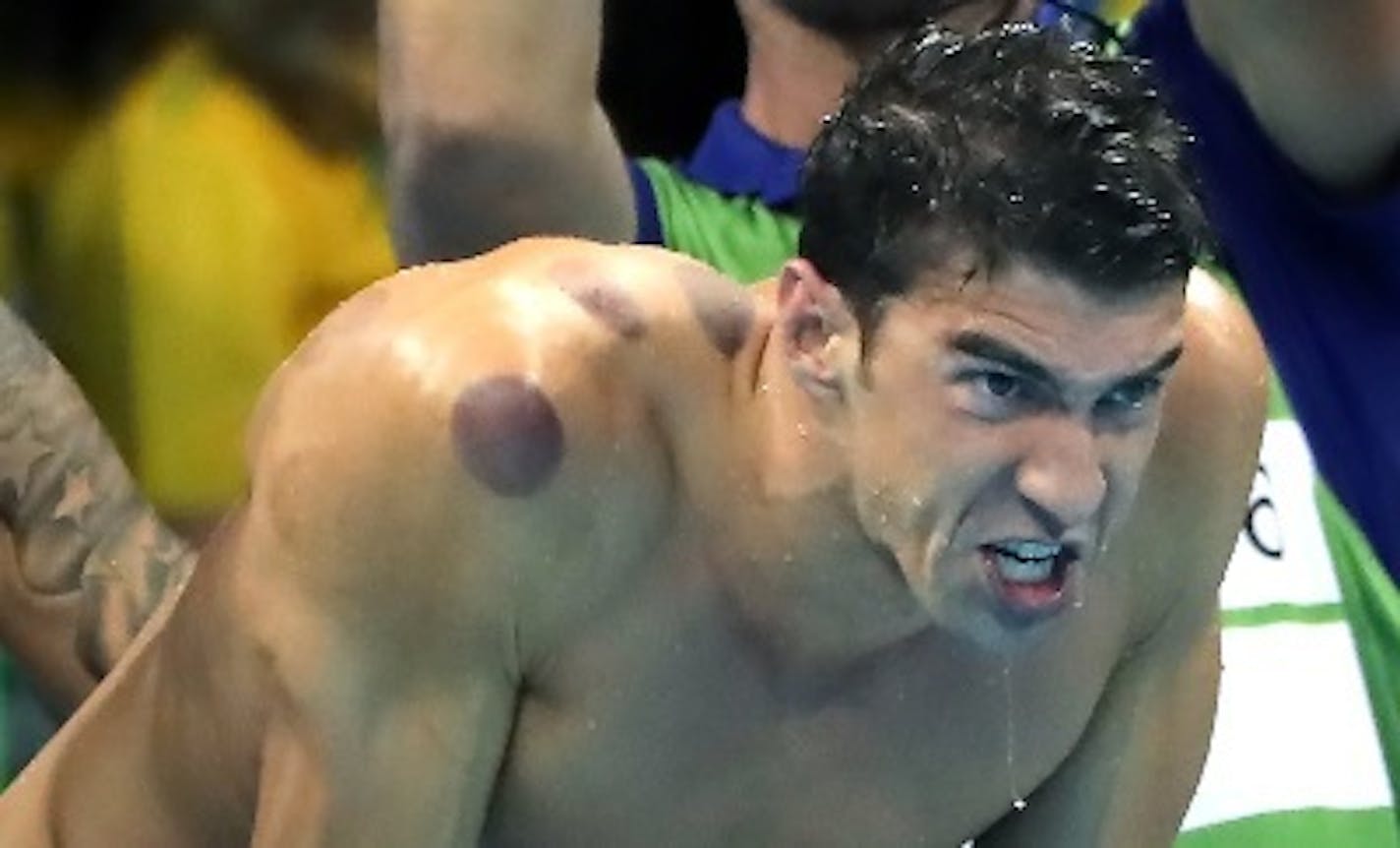 Olympic swimming sensation Michael Phelps is certainly making his mark in Rio, sporting large circular bruises on his body over the weekend. They were the tell-tale signs of a healing technique called "cupping" used by a growing number of athletes to loosen tight muscles and speed up recovery time.