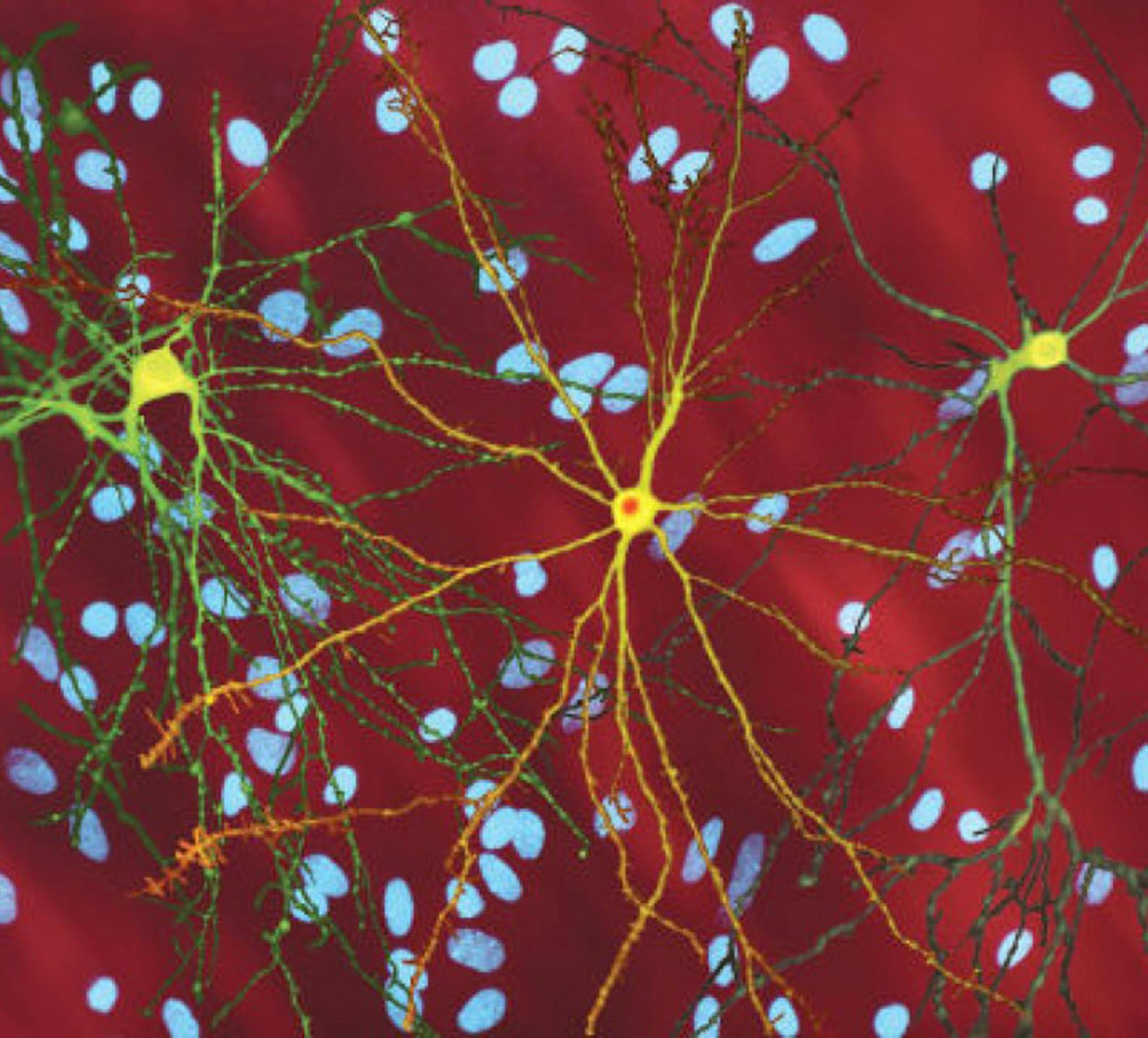 Neurons with a disease-associated version of huntingtin, the protein that causes Huntington’s disease. The neuron in the center (yellow) contains an abnormal intracellular accumulation of huntingtin called an inclusion body (orange). (Dr. Steven Finkbeiner, Gladstone Institute of Neurological Disease.)