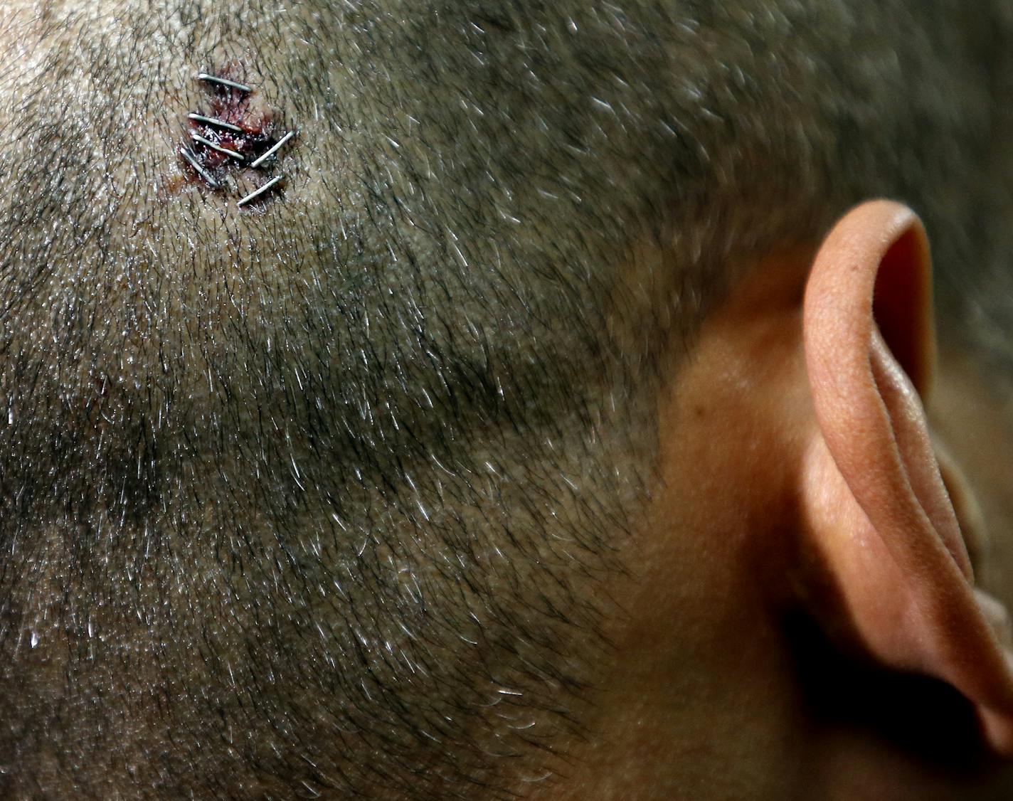 University Market owner Mohamed S. Ahmed had staples to seal a head wound sustained during in a robbery at his store. ] CARLOS GONZALEZ cgonzalez@startribune.com - December 18, 2013, Minneapolis, Minn, University Market, Store owner Mohamed S. Ahmed, 41, had the &#x201a;&#xc4;&#xfa;back of his skull split open pretty good&#x201a;&#xc4;&#xf9; from being pistol-whipped by one of the suspects, said Matt Dosser, the armed citizen who came upon the unfolding crime scene and cared for Ahmed until poli