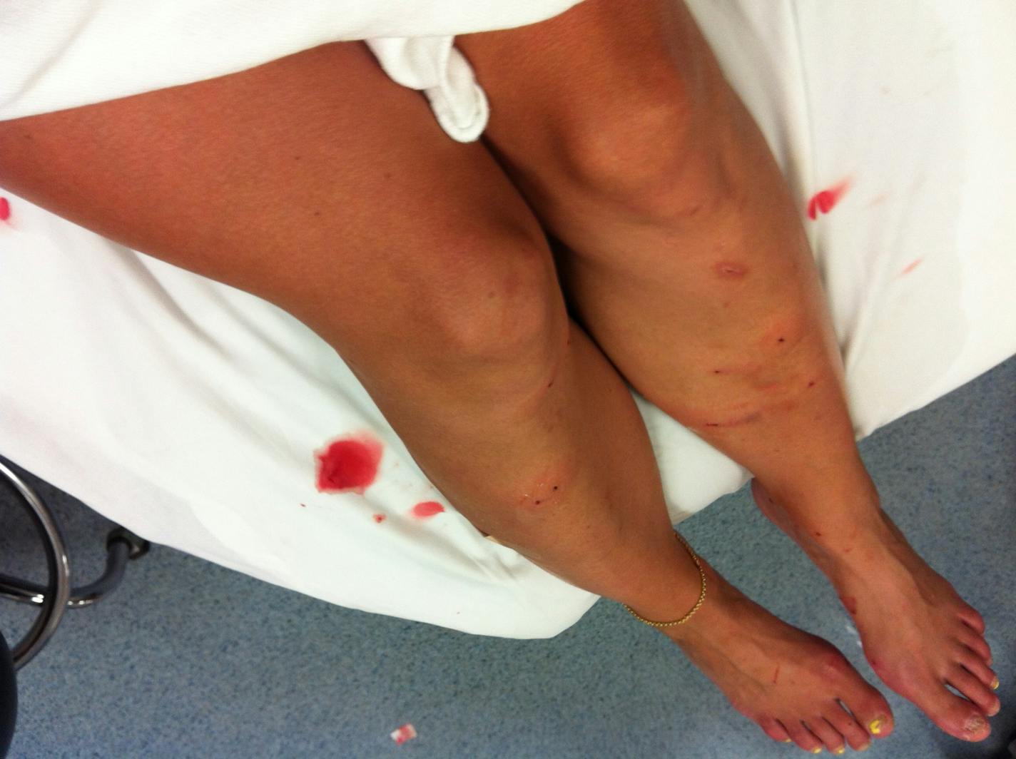 Leah Prudhomme's legs after she was attacked and bitten by an otter while training in Island Lake near Duluth.