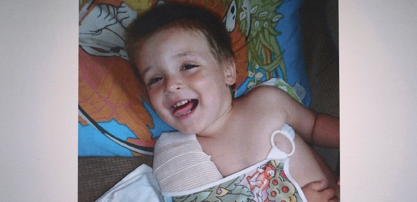 Public outrage over the abuse of 4-year-old Eric Dean, photographed here with a broken arm, triggered far-reaching reforms to Minnesota's child protection system.