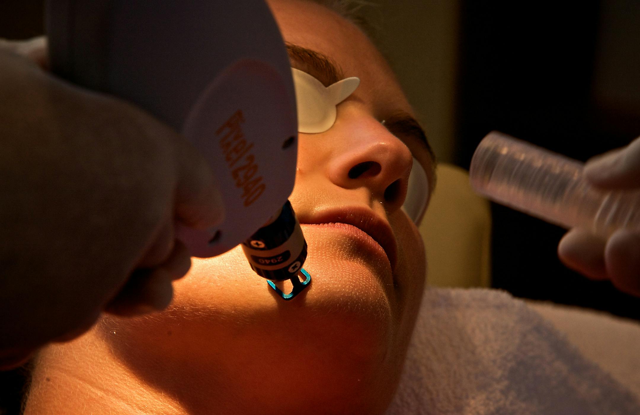 Dr. Charles Crutchfield, Crutchfield Dermatology, performs a pixel skin resurfacing on Cassandra Voeller, a member of his staff. A laser pulse creates tiny holes in the skin, which the body replaces with new, healthy tissue.