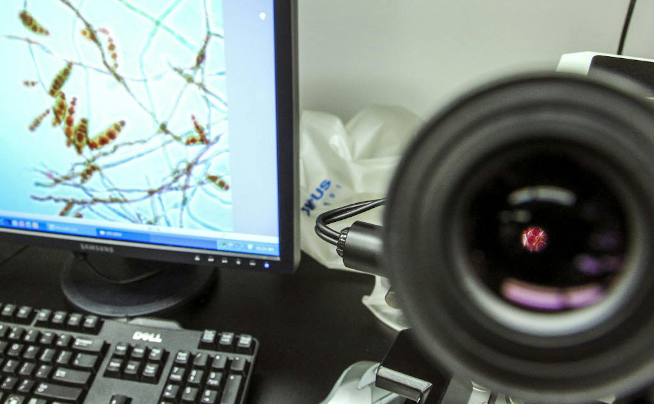 A closeup view through the lens of a microscope and magnified on the computer screen of the meningitis causing fungus Exserohilum rostratum at the Mycotic lab at the Centers for Disease Control and Prevention.