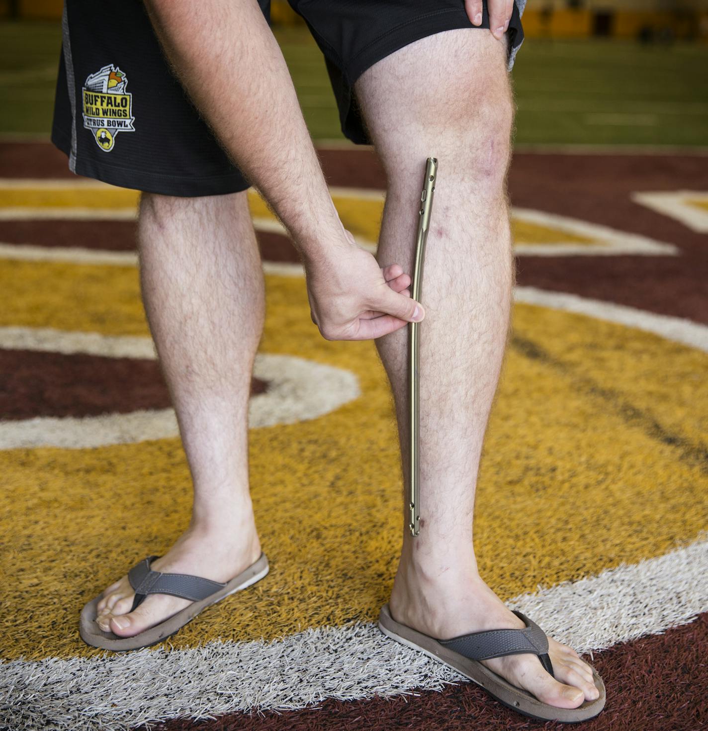 Jon Christenson showed where the steel rod was place in his left leg.