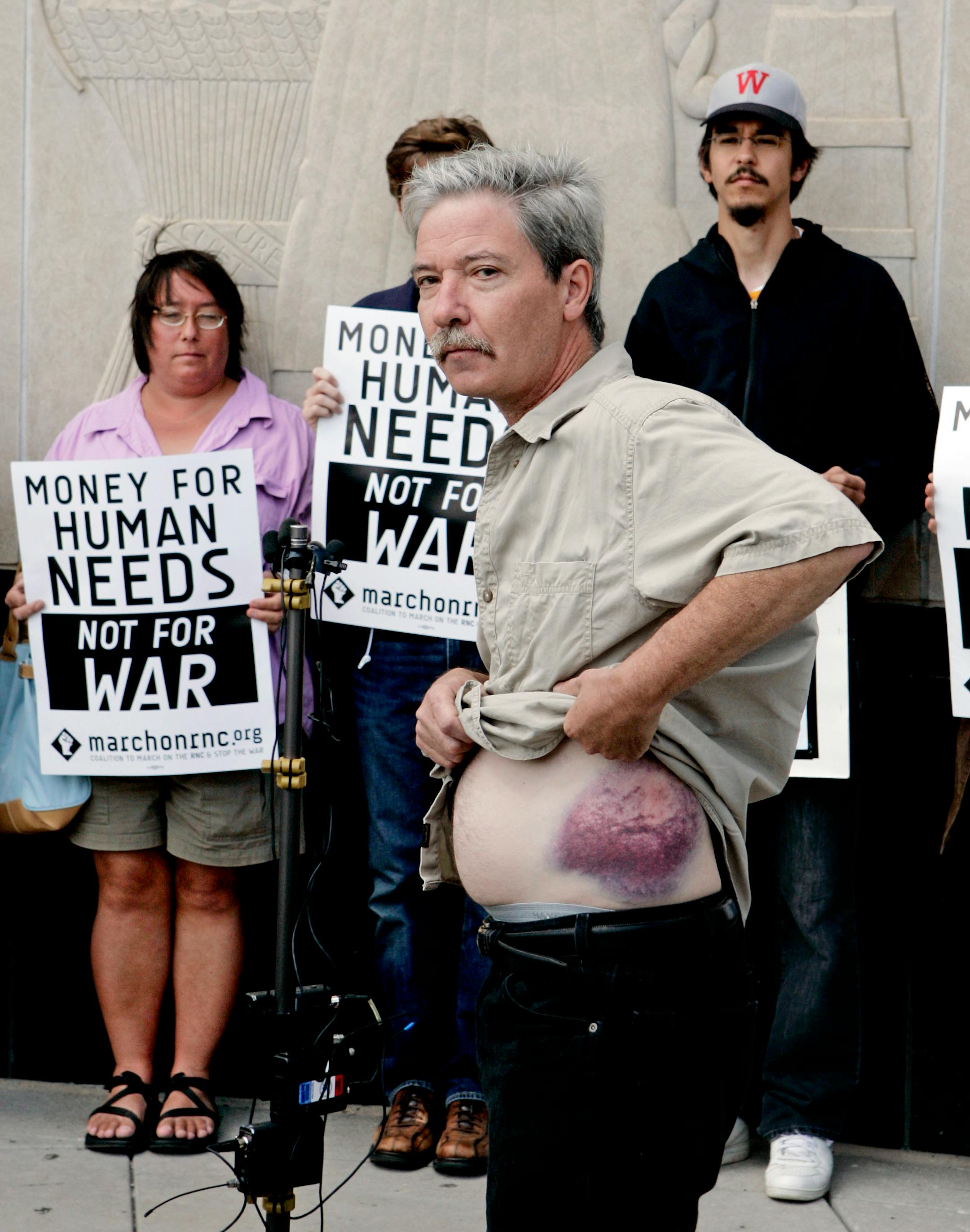 Mick Kelly showed the bruise the day after he said he got hit by a projectile fired by riot police at RNC protesters on Sept. 4 near the Capitol.