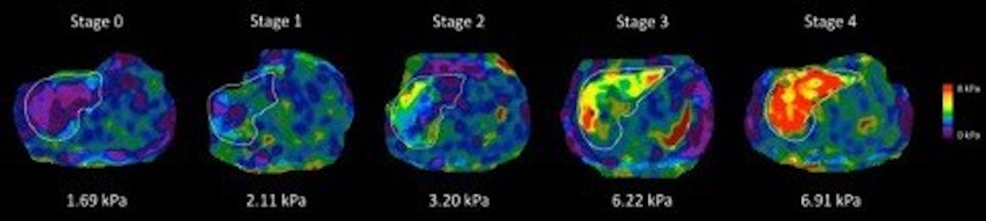 This series of actual patient MRE liver scans shows five different patients with progressively more severe stages of liver fibrosis. Tissue stiffness is measured in kilopascals, or kPa, and the warmer colors indicate a greater tissue stiffness,
(Images courtesy of Resoundant)