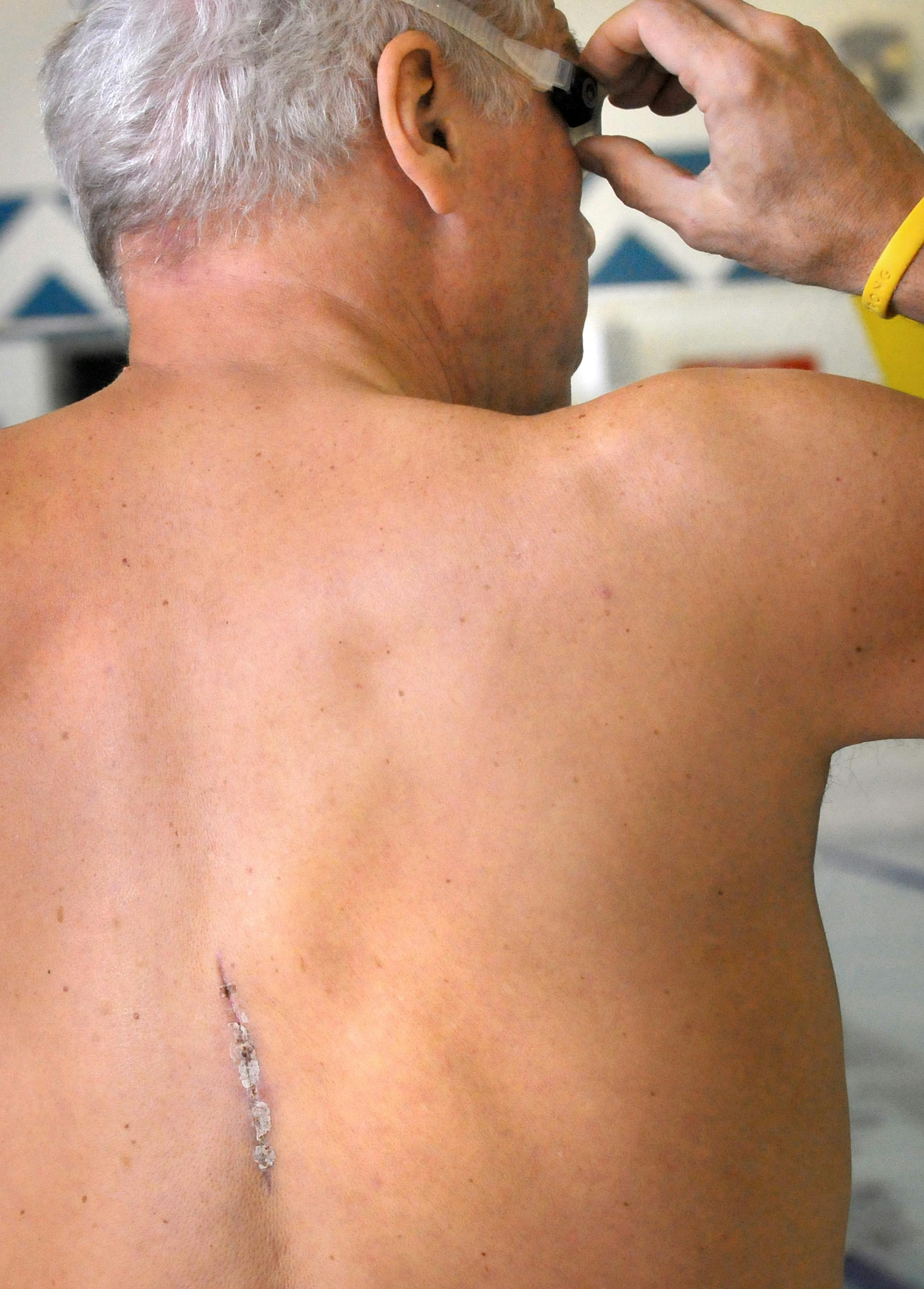 Ron Troyer of Hudson, Wis., says he doesn't care whether his spinal surgeon got payments from the maker of the device that relieved his searing back pain.