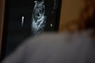An ultrasound of a fetus.