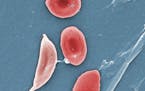 This 2009 colorized microscope image shows a sickle cell, left, and normal red blood cells of a patient with sickle cell anemia. The mutation that cau