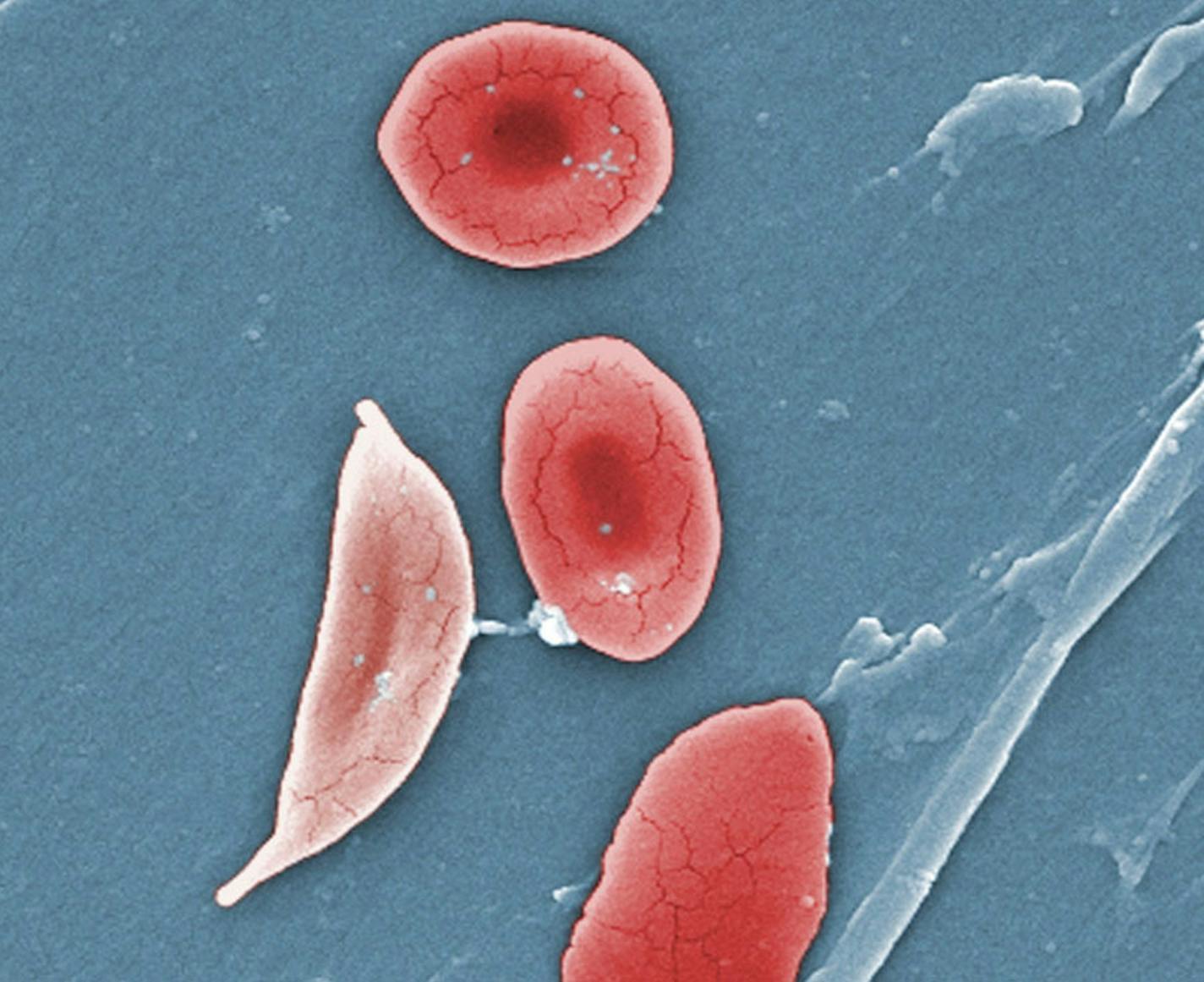 This 2009 colorized microscope image shows a sickle cell, left, and normal red blood cells of a patient with sickle cell anemia. The mutation that causes sickle cell anemia has endured for more than 250 generations.