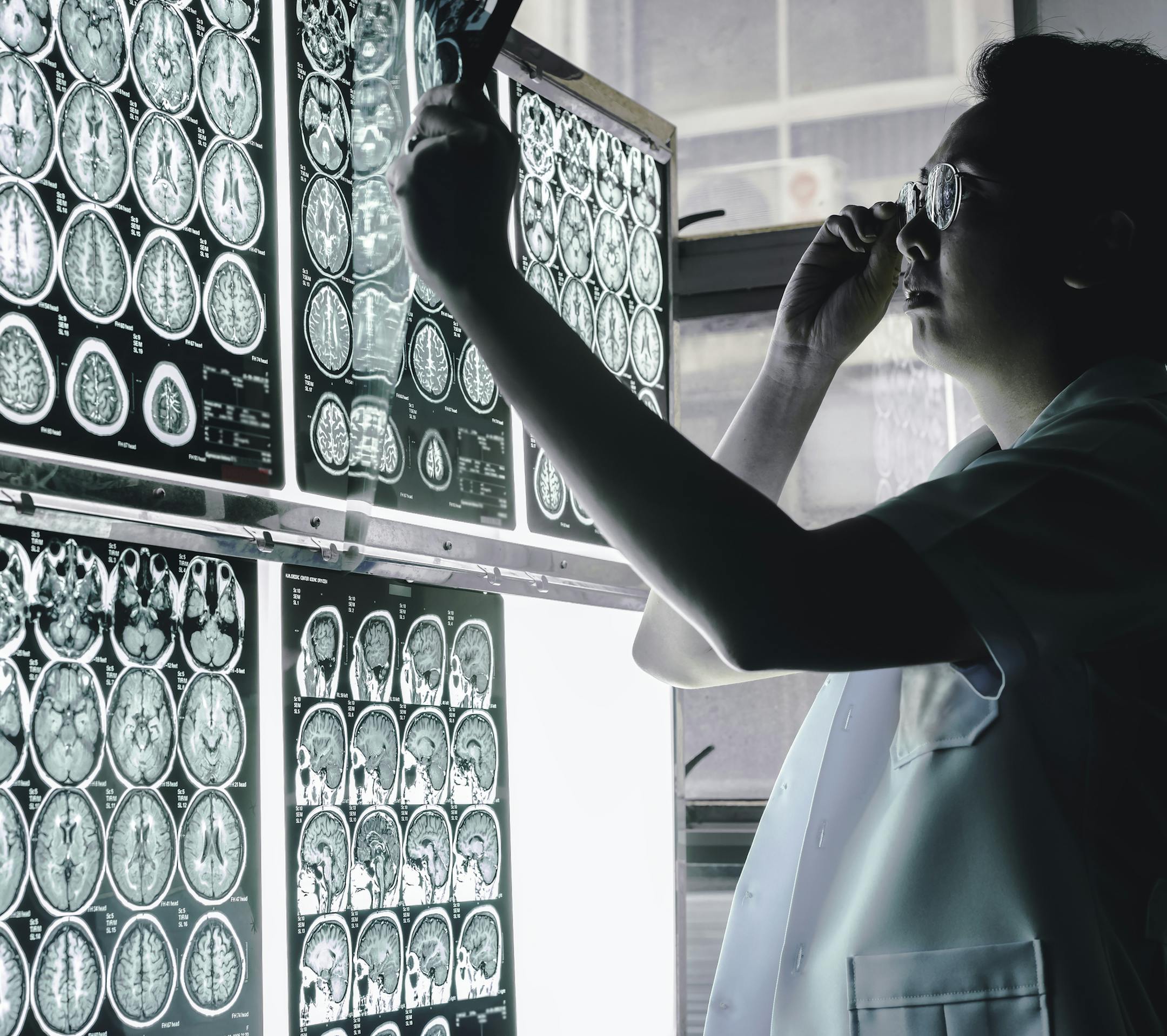 This MRI film indicated to brain atrophy was diagnostic to be Dementia. (Dreamstime/TNS)