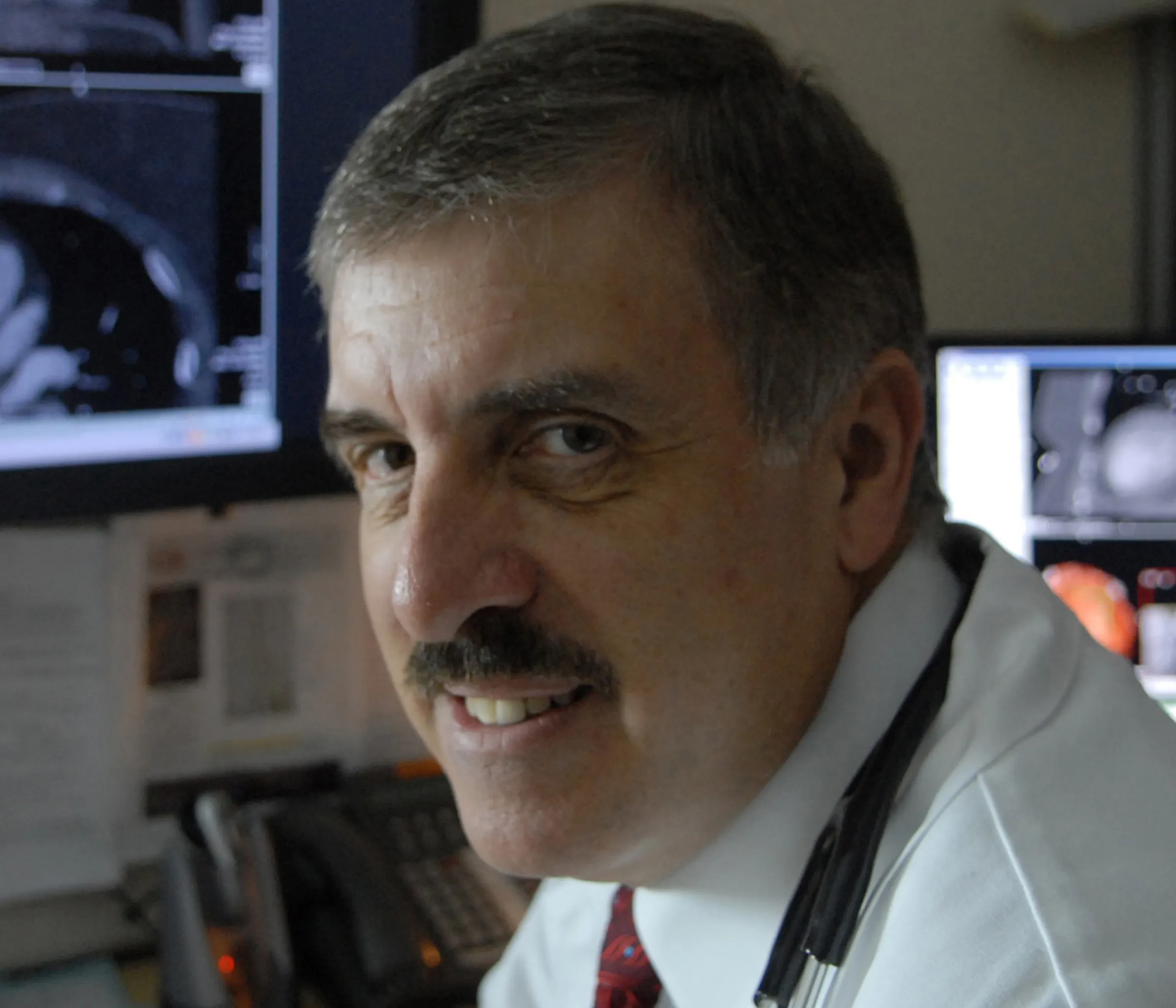 New research showing possible causes of stroke after heart procedures