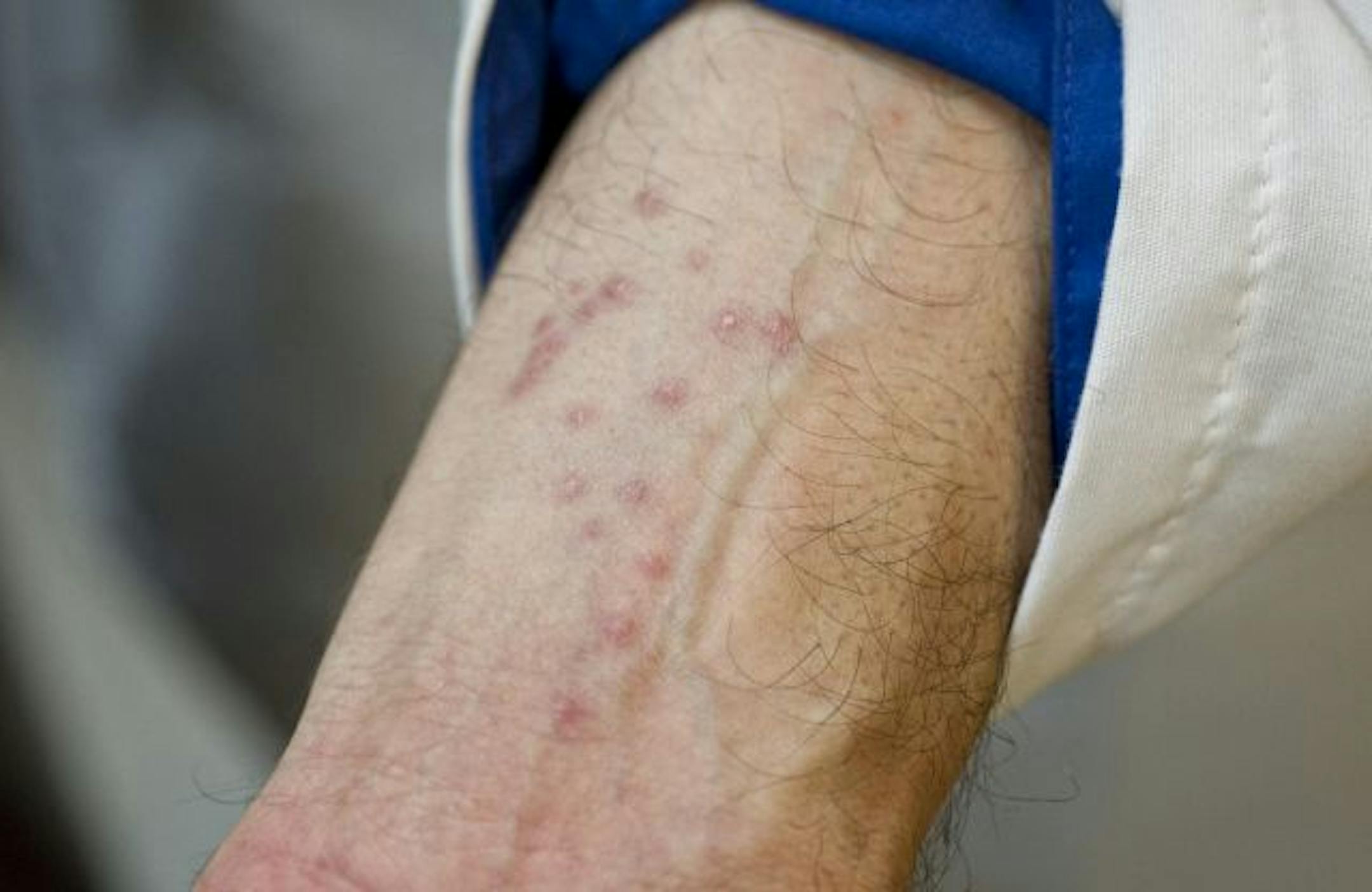 Dr. John Barcay, an Ecolab senior scientist showed the effects of bedbug bites. He said he is part of the 40 percent of the human population affected this way since most show no reaction to the bites.