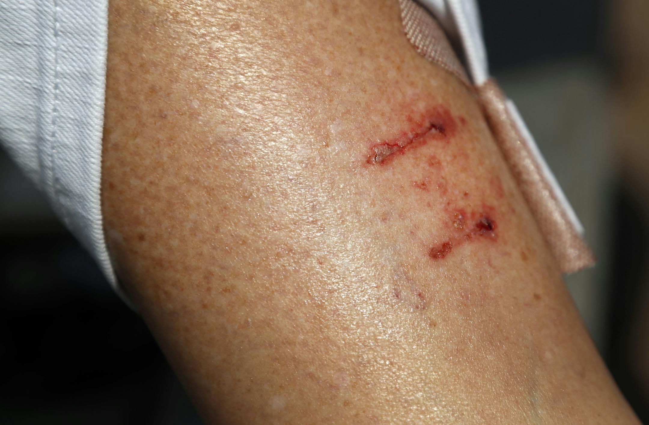 Bite marks on the leg of Susan Obmoin of Eagan were she was bitten by a fox near Lake Harriet.