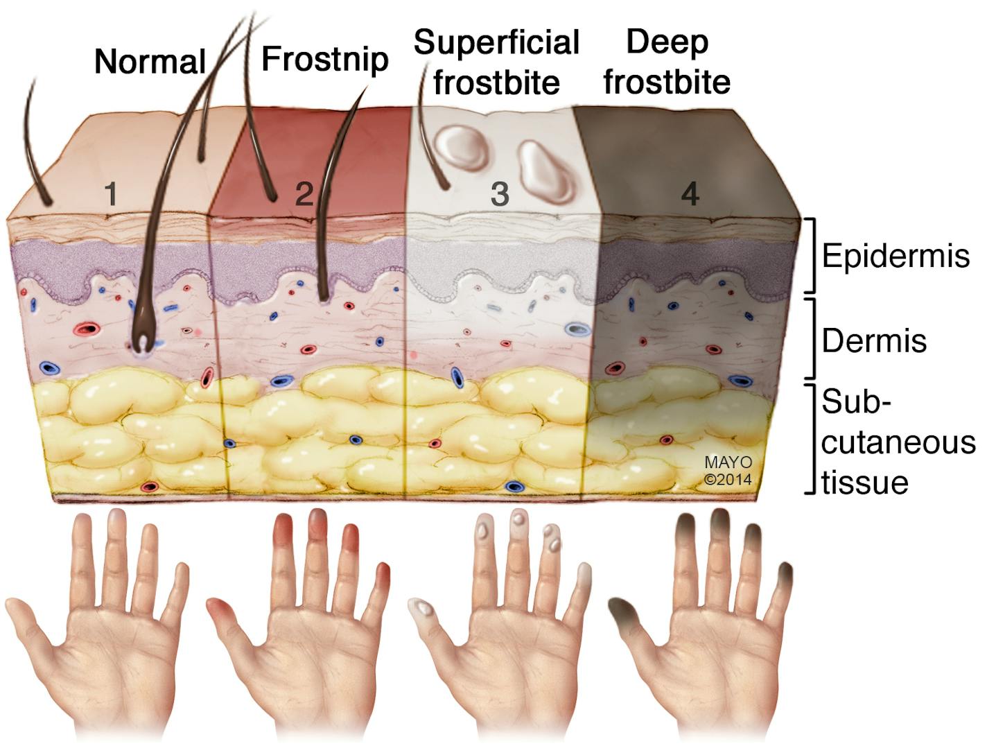 The stages of frostbite