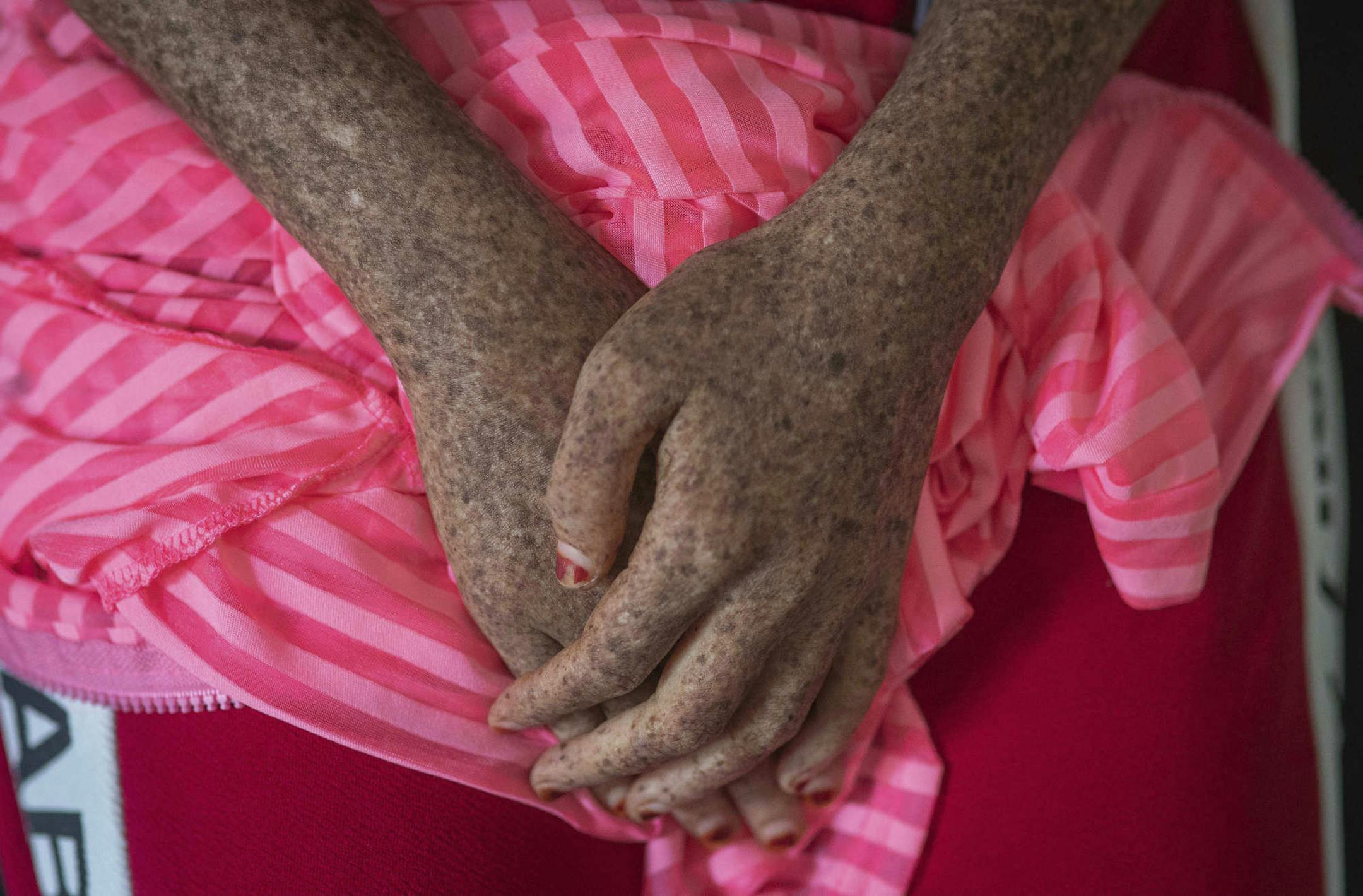 In this Wednesday, July 24, 2019 photo, a girl affected by a rare disorder called xeroderma pigmentosum, or XP, waits for a skin checkup with her family at a hospital in Casablanca, Morocco. The disorder affects about 1 in 10,000 people in North Africa _ more than 10 times the rate in Europe and about 100 times the rate in the United States, according to Dr. Kenneth Kraemer, who researches XP at the U.S. National Institutes of Health. (AP Photo/Mosa'ab Elshamy)