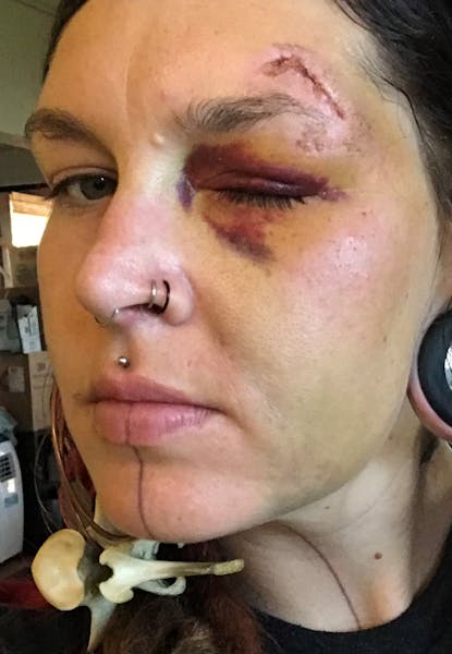 Police shot Samantha Wright in the face with a less-lethal projectile on May 30, 2020, leaving her with permanent eye damage.