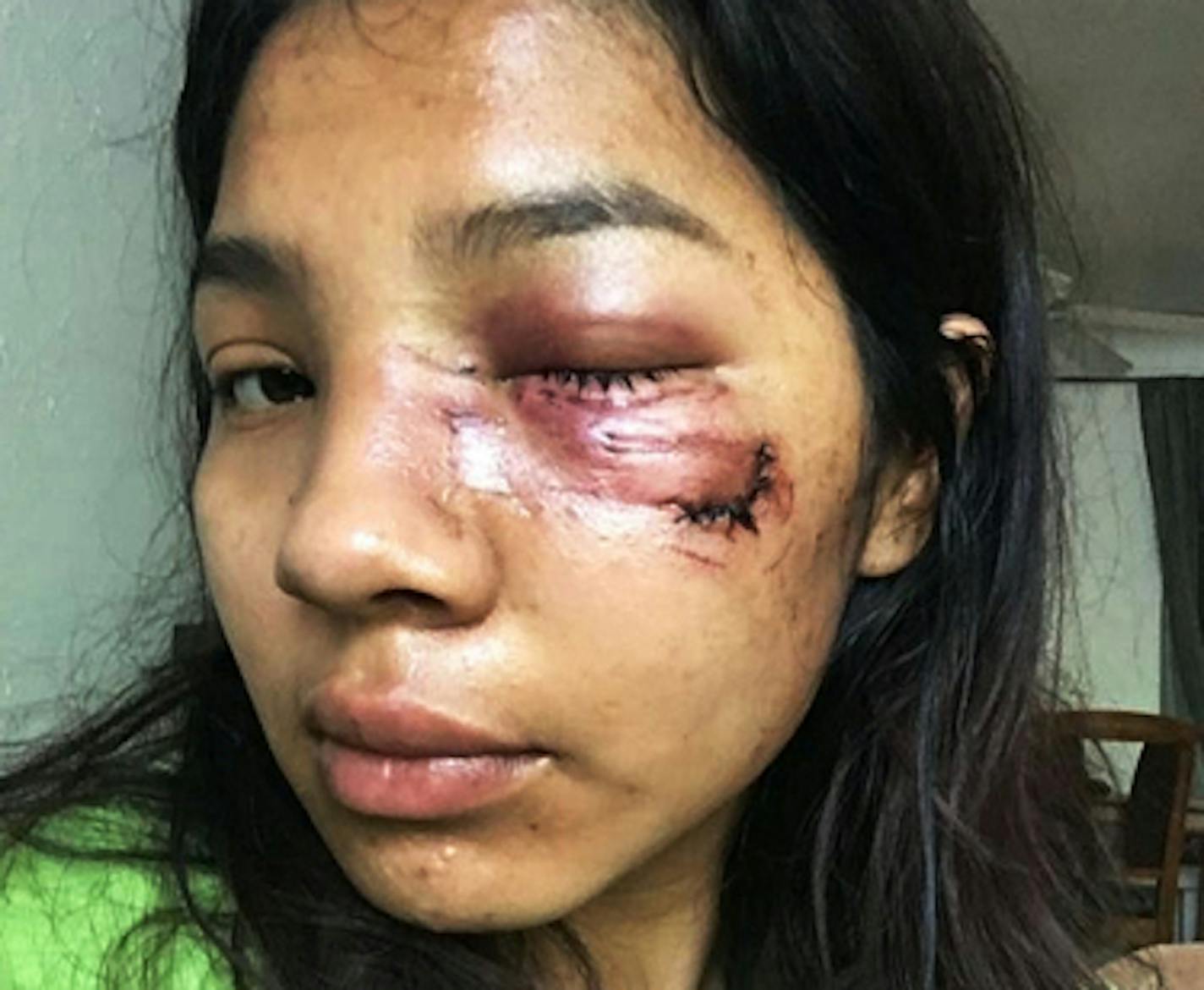 A federal lawsuit filed Tuesday alleges that Minneapolis police officers without provocation fired a non-lethal round into the face Graciela Cisneros then left her without treating her or trying to arrest her. Cisneros suffered a broken cheekbone and other injuries, according to her suit against the city of Minneapolis and others. She is seeking damages in excess of $5 million.