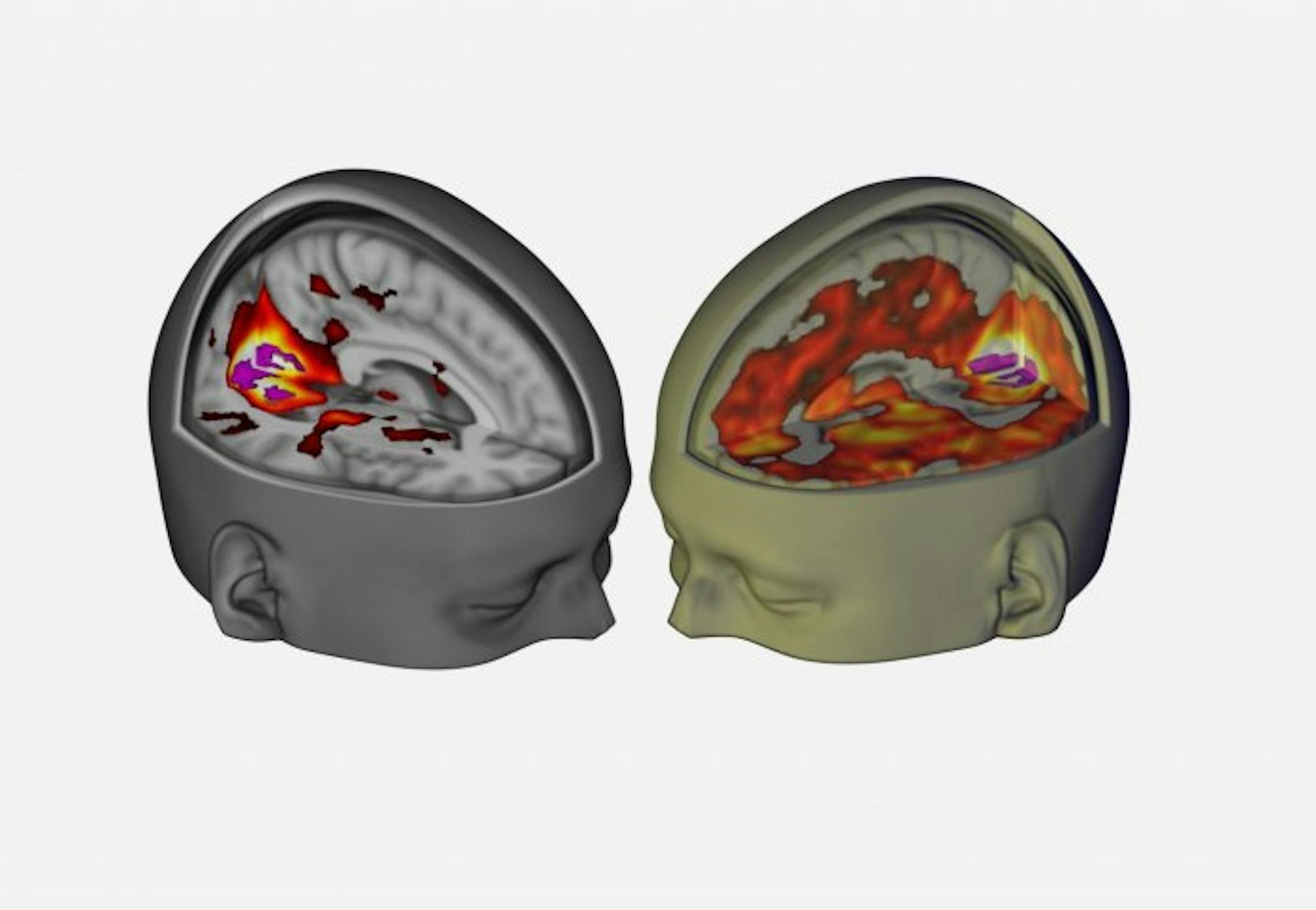 In a first, scientists use brain scans to reveal how LSD affects brain activity. Photo courtesy of Imperial College, London.