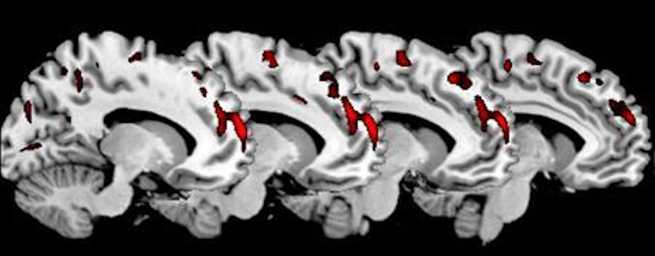 A brain scan shows areas of reduced gray matter volume in the medial prefrontal cortex of the brain of the psychopathic group of antisocial men compared to the non-psychopathic group of antisocial men. REUTERS/Institute of Psychiatry King's College London/Handout