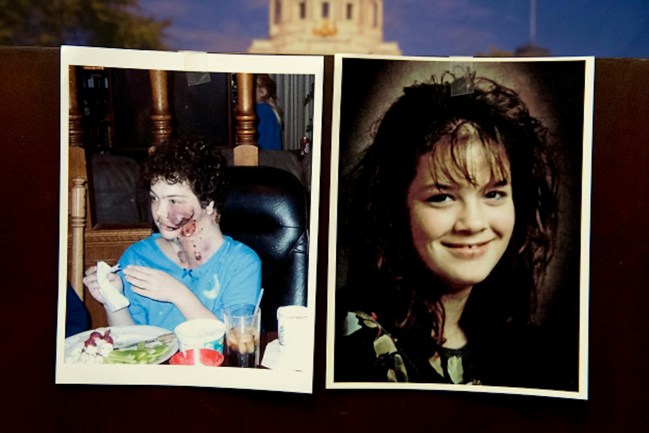 Joni Whiting's daughter Stephanie who died after multiple surgeries following melanoma skin cancer.  Marijuana allowed her to eat without vomiting and reduced her pain. Thursday, May 2, 2013     ]   GLEN STUBBE * gstubbe@startribune.com