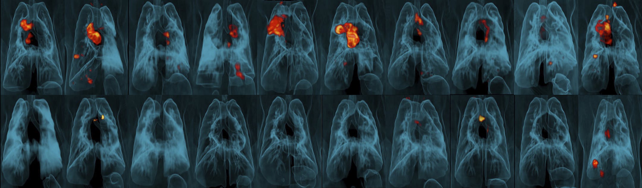 This image provided by the University of Pittsburgh School of Medicine and the National Institute of Allergy and Infectious Diseases shows a collection of lung scans of 20 monkeys who were exposed to tuberculosis after receiving different forms of a TB vaccine. Monkeys in the top row received skin-deep shots, and those in the bottom row were given intravenous injections. The intravenous vaccine protected far better, as shown by TB-caused inflammation seen in red and yellow. (JoAnne Flynn, Alexan
