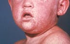 The face of a boy after three days with a measles rash.(Centers for Disease Control and Prevention/TNS ORG XMIT: 1403504