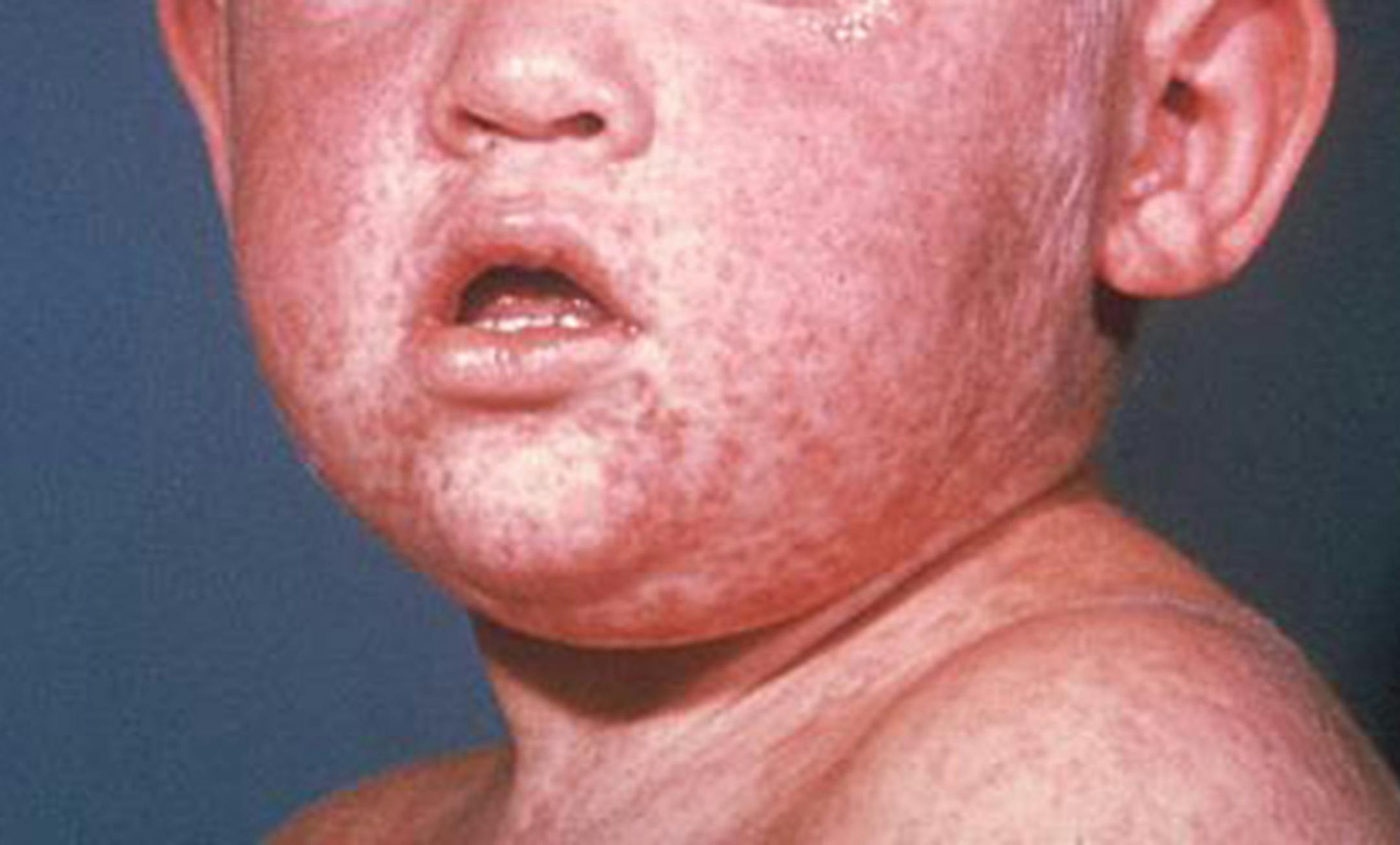 The face of a boy after three days with a measles rash.(Centers for Disease Control and Prevention/TNS ORG XMIT: 1403504