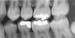 Dental X-ray of Teeth with Metal Fillings