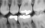 Dental X-ray of Teeth with Metal Fillings