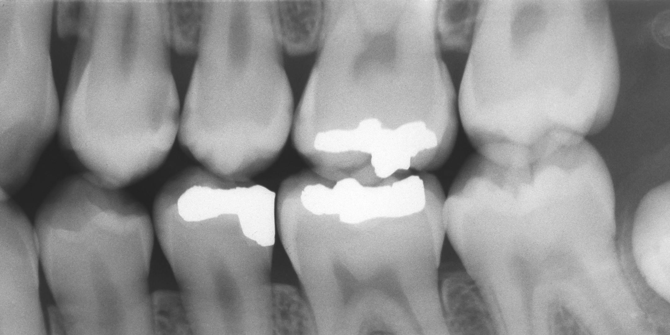 Dental X-ray of Teeth with Metal Fillings