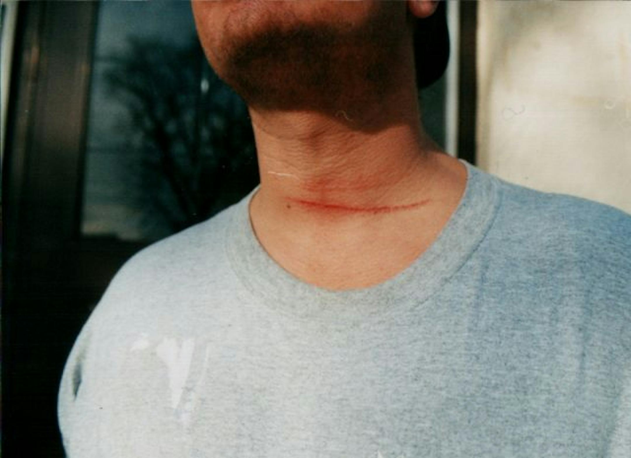 The client�s injuries after the 2004 assault. Source: Ramsey County court records