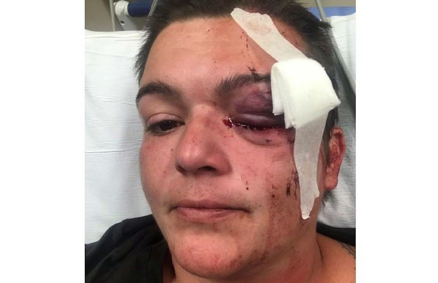 Journalist Linda Tirado was blinded in one eye after she was struck by a projectile she said was fired by Minneapolis police. Credit: Provided photo