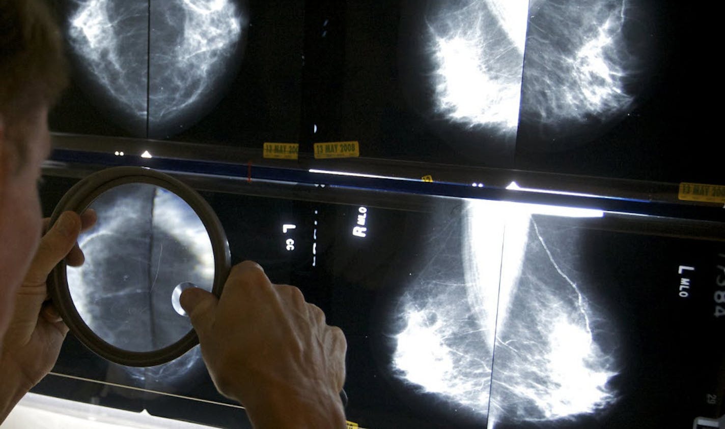 A radiologist uses a magnifying glass to check mammograms for breast cancer in Los Angeles.