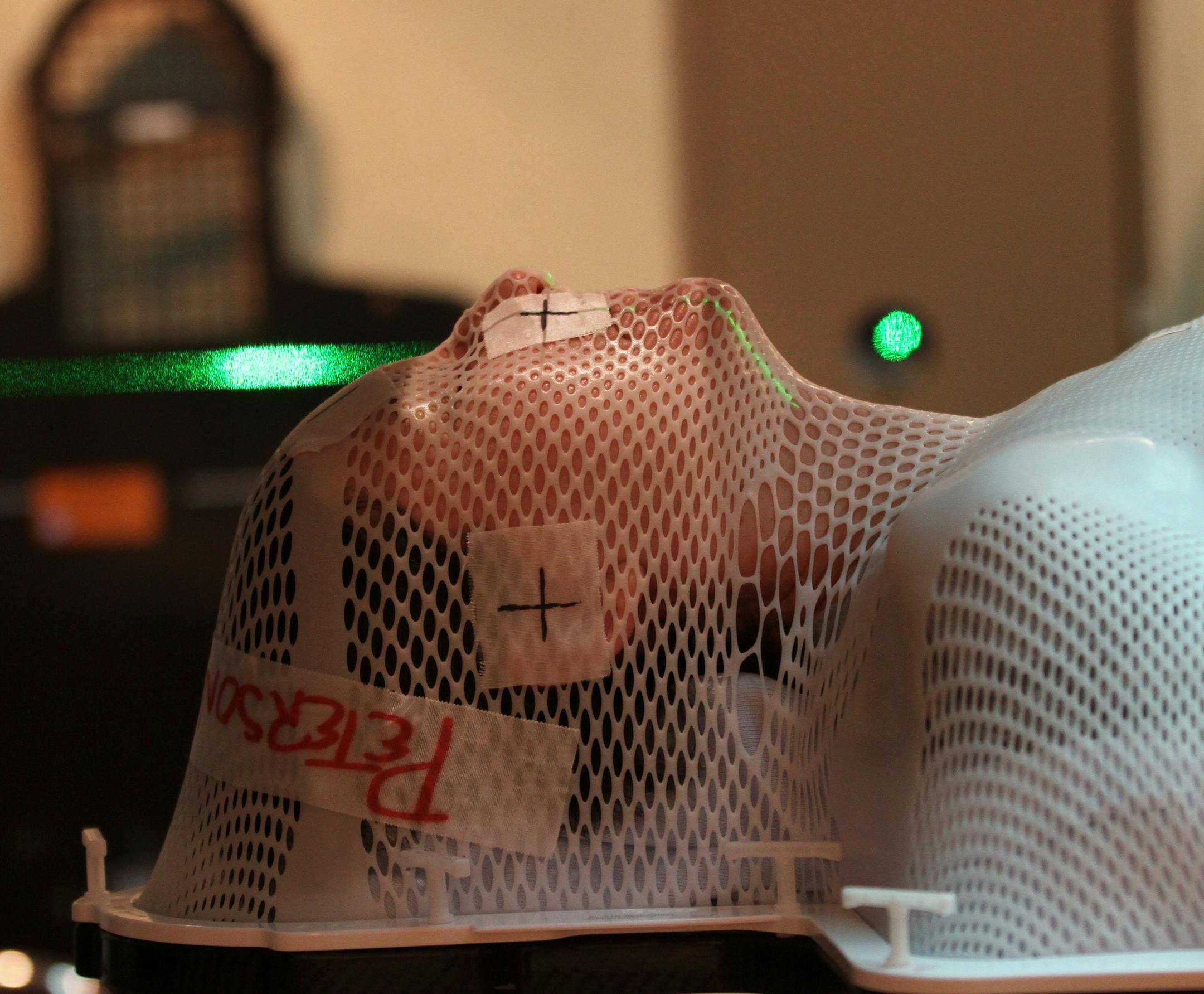 Georgette Peterson of Newport MN., wore a form fitting face mask while getting radiation. treatment in a linear accelerator at Minnesota Oncology in St. Paul. The mask keeps the patient from moving during the treatment. Peterson is being treated for a non-cancerous brain tumor and the treatment was number eighteen of the twenty eight she will have. Photographed on 2/21/13.] Bruce Bisping/Star Tribune bbisping@startribune.com Georgett Peterson/source.